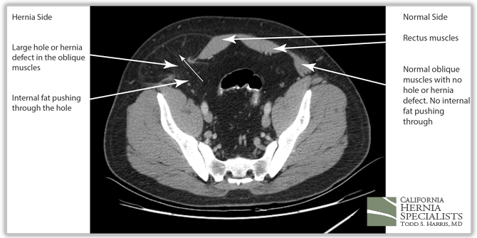 Spigelian Hernia CT image